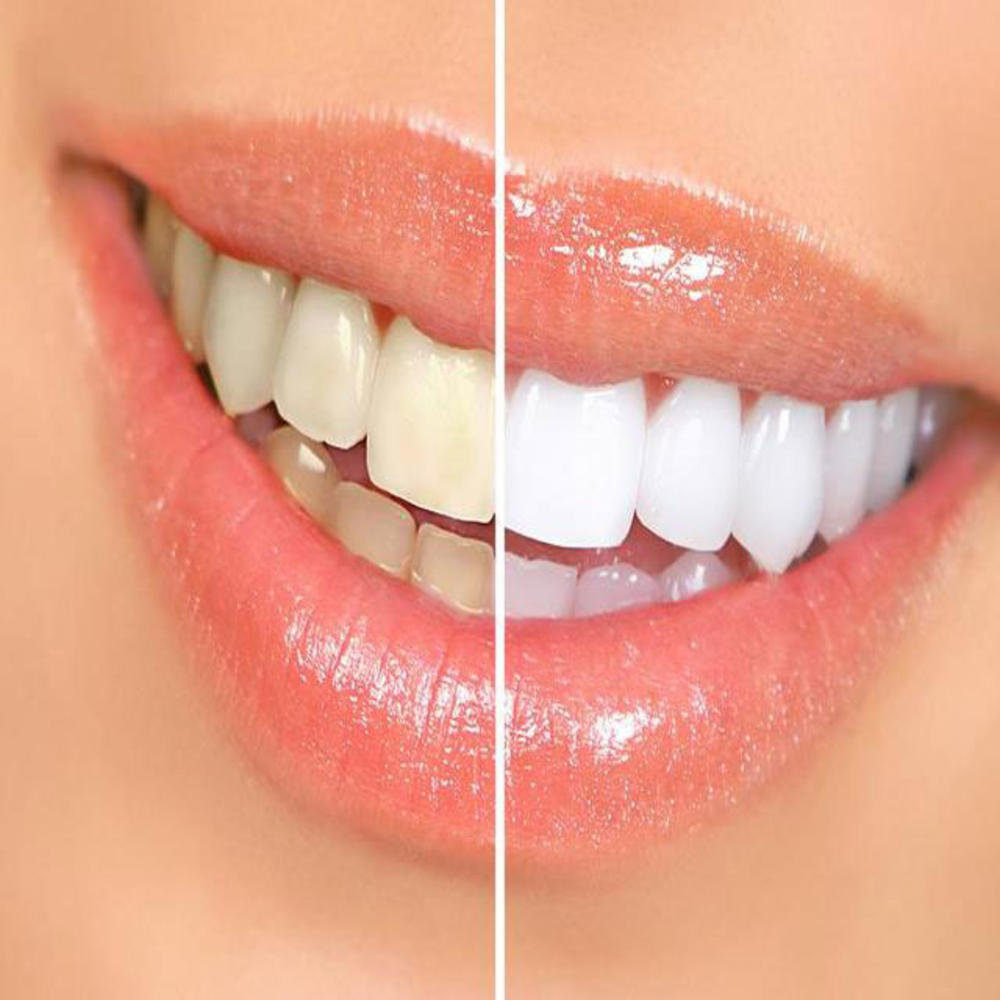 Go White Smiles Home Teeth Whitening Kit