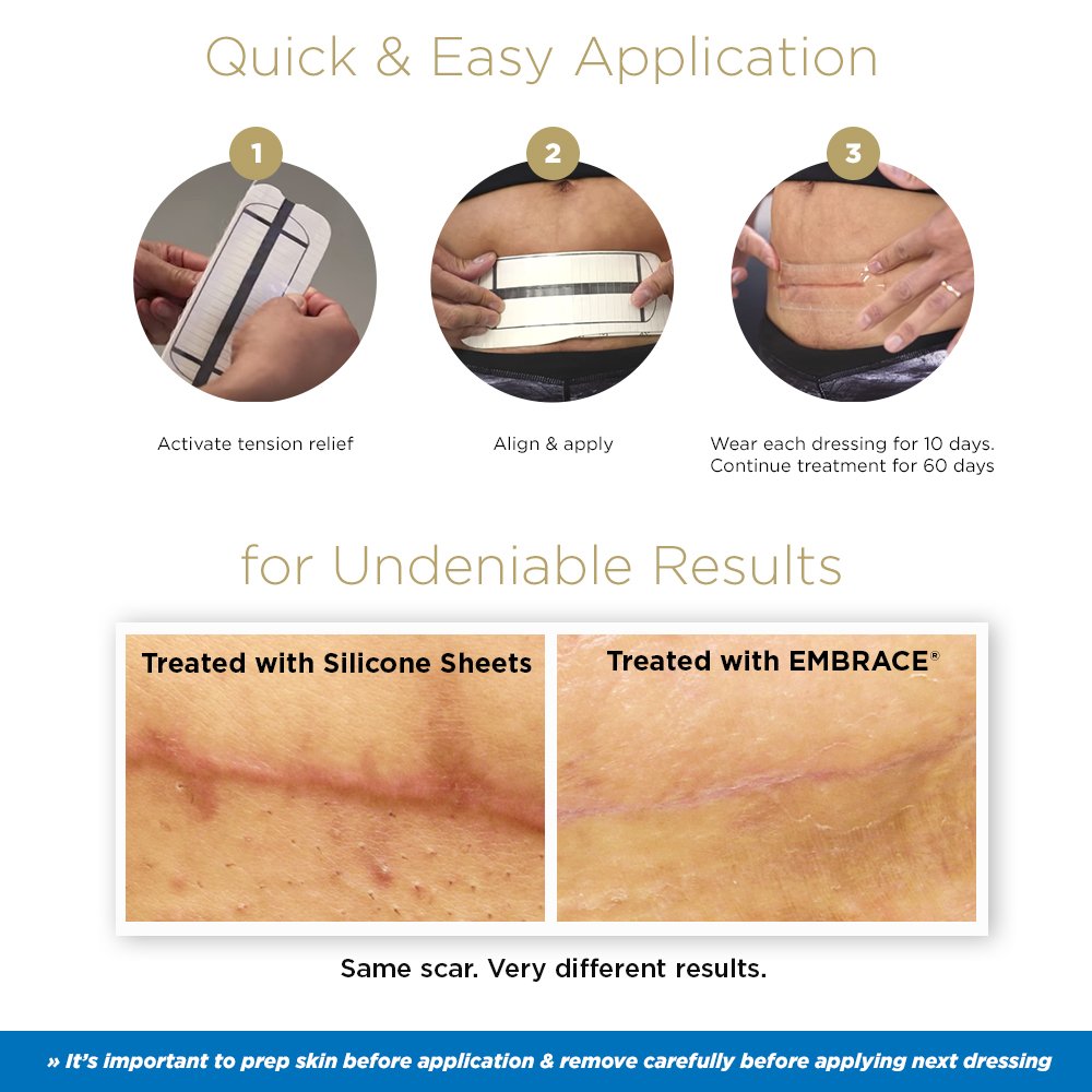 Embrace Active Scar Defense Silicone Sheets For New Scars Size Active Scar Defense Silicone Sheets