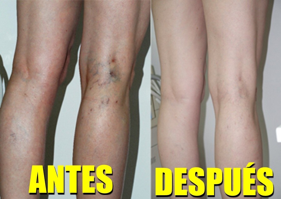 te para eliminar varices