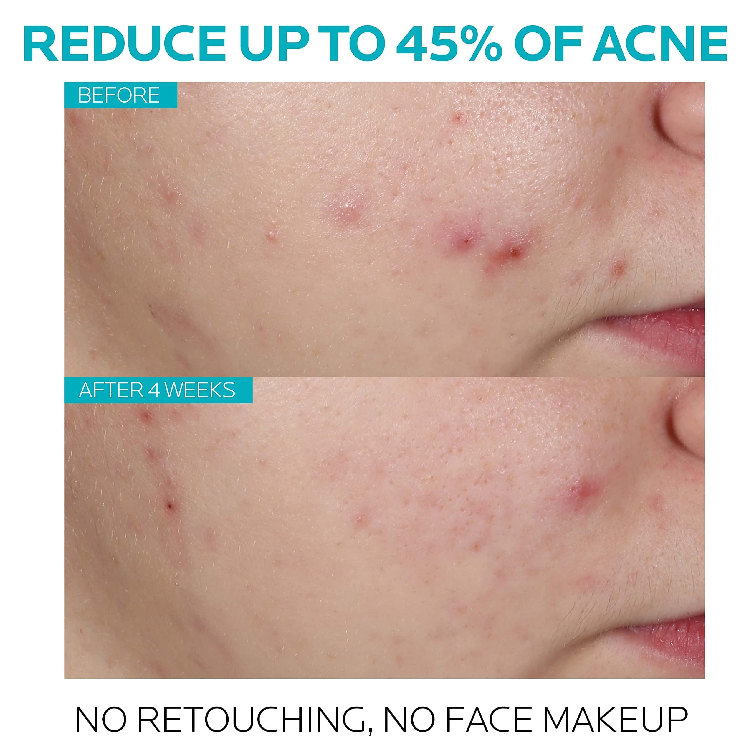 La Roche-Posay Effaclar Salicylic Acid Acne Treatment to Minimize Pores, Clear Acne Blemishes and Post Acne Marks