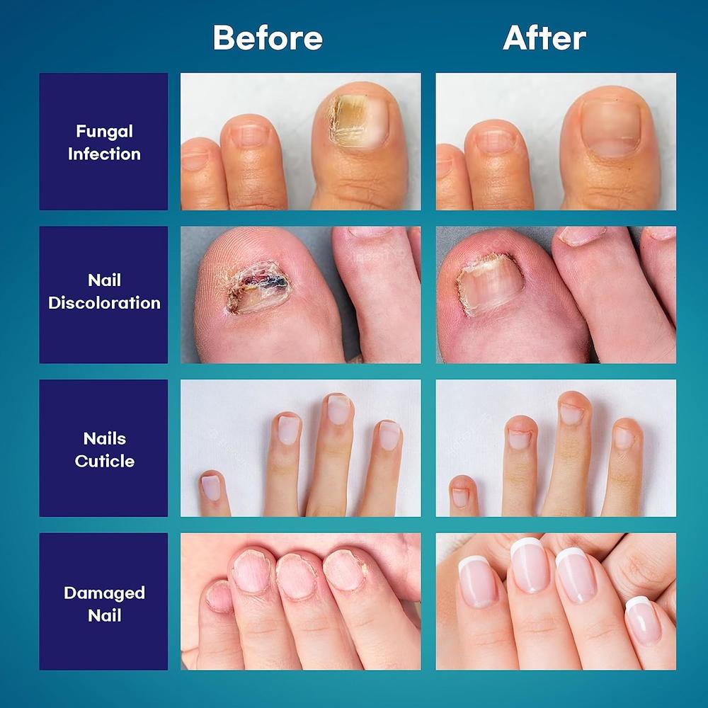 Tobcharm Toenail Fungus Treatment Extra Strength for Toenail & Fingernails, Antifungal Nail Treatment for Athletes Foot, Thick, Broken, D